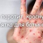 Кір, паротит, краснуха - пам’ятка для батьків