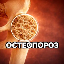 Остеопороз